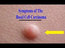 This article does not have the information i am looking for. Basal Cell Carcinoma Information