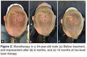 Profollica is a natural hair growth product that blocks dht production, eliminating the source of your hair loss. Studies From Clinically Proven Hair Growth Laser Devices Hairmax Uk