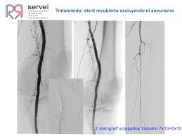 Es peligroso ya que puede obstruir o detener el flujo de sangre a los órganos principales, como el corazón o el cerebro. Tratamiento Endovascular Sobre Aneurisma De Arteria Poplitea Trombosis Recidivante Por Mala Salida Distal Sociedad Espanola De Radiologia Vascular E Intervencionista Servei
