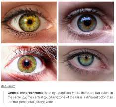 It occurs in humans and certain breeds of. Central Heterochromia Heterochromia Eye Color Facts