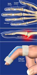 Finger pip extension immobilization splint, type 0 (1) in the form of cylinder casts or gutter splints are used frequently as protection splints for proximal phalanx fractures. Volar Plate Injuries Central Coast Orthopedic Medical Group