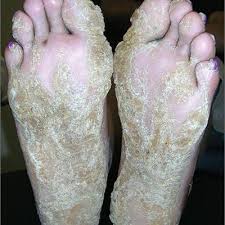 Cracks, thick skin, dead skin, callus, horn and burrs improve apparently. Thickening Of Skin On Feet Mdedge Family Medicine