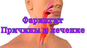 как вылечить горло за один день в домашних условиях Hronicheskij Faringit Lechenie V Domashnih Usloviyah Zdorove Motivaciya Dlya Pohudeniya Pohudenie