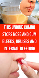 This Unique Combo Stops Nose And Gum Bleeds Bruises And Internal Bleeding Internal Bleeding Bruises Nose
