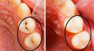 Home Decor Clever And Healthy How To Fill Cavities Without Going To The Dentist Heal Cavities Cure Tooth Decay Teeth Health