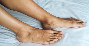 Image result for mosquito bite