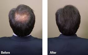 Regenerates the hair from root to tip, vitalizes the scalp house, prevents dandruff. My Hair Care Products For Hair Loss Zaza Iman Lifestyle Blogger