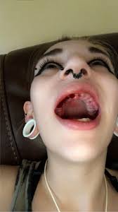 Here's my complete denture removal 😅 That hurts from hell..😂 Photos 1 and  2 right after removal. Photos 3 and 4 the next day. Photos 5 and 6 after 3  days. Photo 7 after 4 days.