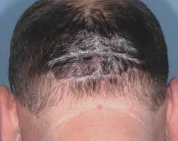 Adverse reactions reported in ≥5% of patients were (otezla%, placebo%): Plaque Psoriasis Before And After Photos Otezla Apremilast Results