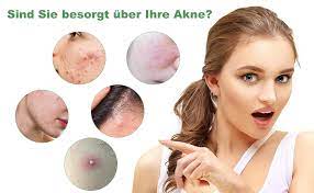 Im fall von akne ist grüner tee immens helfen gefunden worden. Acne Pads Anti Pimple Pads Makse Pore Cleaner Pads Acne Control Pads For Shrinking Pores Oil Control Improves The Acne Problem Of The Skin And Repairing The Skin Condition Amazon De Beauty