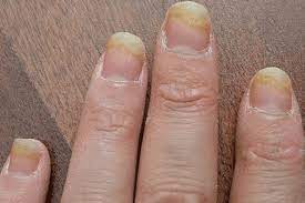 This is because the feet are the fungi that cause the development of nail fungus are called dermatophytes, which are microscopic organisms that thrive in warm, moist environments. Can You Get Nail Fungus From Acrylic Nails Nailstip