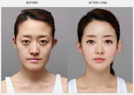 20 Outrageous Before And After Plastic Surgery Photos You Will Struggle To Believe Korean Plastic Surgery Plastic Surgery Korea Plastic Surgery
