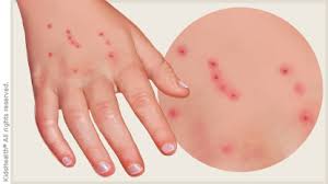 Image result for bedbug bites look like