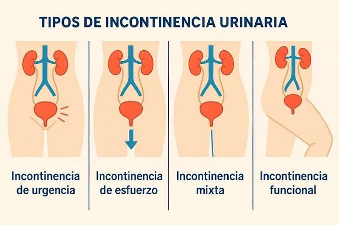 Tipos de incontinencia
