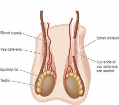 Image result for Vasectomy