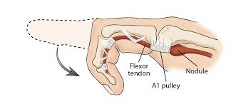 Damage to it, unless i suppose it is extremely severe and affecting more superficial tissues, should not be visible externally. Trigger Finger Trigger Thumb Orthoinfo Aaos