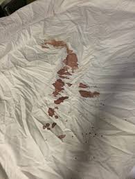 If you want to remove blood stains quickly, you will need to wash the blood off as soon as possible. Expected To Clean A Guest S Blood After Stay Airbnb Hell