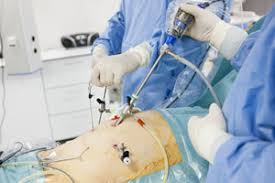 Chirurgia laser pentru corectarea vederii este o metoda moderna, o procedura revolutionara, care lucreaza pentru a remodela eficient în unele cazuri, în fața ochilor apar muște sau pete negre. Chirurgie LaparoscopicÄƒ Acum 3000 Lei Reginamaria Ro