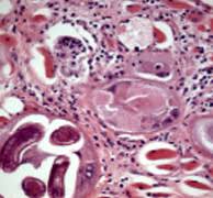 Trichinosis: clinicopathological case