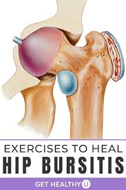 9 Best Exercises For Hip Bursitis In 2020 Best Exercise For Hips Hip Bursitis Exercises Bursitis Hip