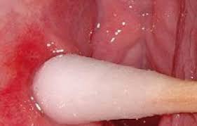 Image result for Vulvitis