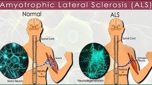 Es una enfermedad hereditaria que afecta a algunas células nerviosas del cerebro, provocando su desgaste. Esclerosis Lateral Amiotrofica Elacyl