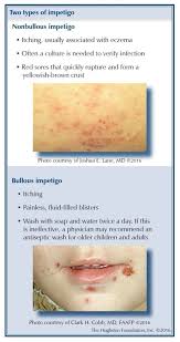 Image result for Impetigo