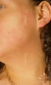 Image result for Scarlet Fever
