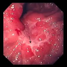 As a result, it is very much tough to identify stomach cancer and take necessary steps. Stomach Cancer Digestive Disorders Merck Manuals Consumer Version