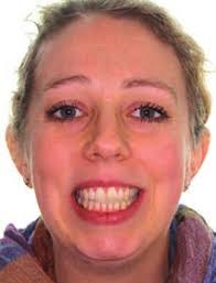 Clinical Experience with the Use of Pulsatile Forces to Accelerate Treatment