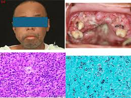 Image result for granuloma gum disease