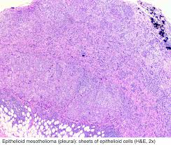 (a) patients with epithelioid dmpm had a significantly better median survival (16.2 months) compared with biphasic (7.0 months) and sarcomatoid (3.8 months). Pathology Outlines Mesothelioma Peritoneum Epithelioid