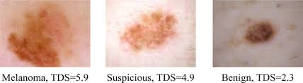 Squamous cell skin cancer survival rate Melanoma Skin Cancer Detection Method Based On Adaptive Principal Curvature Colour Normalisation And Feature Extraction With The Abcd Rule Springerlink