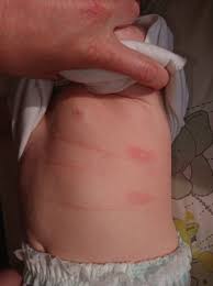 What are the symptoms of food allergy in a child? Baby Porridge Causing Allergic Reaction Rash Babycentre