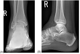 Image result for Ankle XRay
