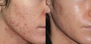 Blue Light Laser Acne Treatment San Diego Ca Clderm