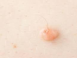 Razor burn, an uncomfortable skin irritation that can happen after you shave, may also cause small bumps and blisters in. Why Some Warts Have Hair Growth Health Clover