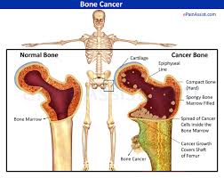 Bone pain pain caused by bone cancer usually begins with a feeling of tenderness in the affected bone. Bone Cancer Types Stages Causes Symptoms Treatment Surgery Radiation Chemotherapy