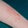 Von einer allergie gegen ppd sind immer mehr menschen betroffen, dieser stoff wird in sehr vielen. Https Encrypted Tbn0 Gstatic Com Images Q Tbn And9gcsnw8mzqt9tpekl Pd6oswy1xk8wv Eshdzjqpbgdghcvttz9pk Usqp Cau