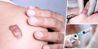 Cách cải thiện sẹo lồi ngày càng to