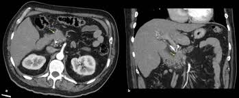 Variz pulmonar: A propósito de un caso y revisión de la literatura