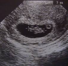 Image result for First Trimester Ultrasound