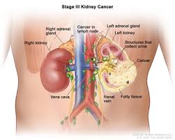 Terms describing the continuum of increasing renal dysfunction and decreasing glomerular filtration rate (gfr). Renal Cell Cancer Treatment Pdq Treatment Health Professional Information Nci Michigan Medicine