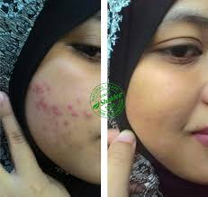 Описание для tips hilangkan jerawat. Tips Hilangkan Jerawat Dan Muka Breakout Semasa Mengandung Umi Nazrah