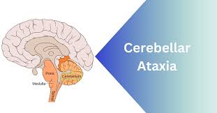 Image result for Ataxia