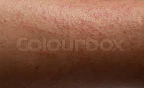 Image result for allergy rash on the legs