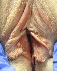 The pubic mouth, inner labia, outer labia. Erosive Lp Bilateral Well Demarcated Glazed Red Patch Over Inner Labia Download Scientific Diagram
