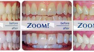 Worlds leading professional teeth whitening company and the only one that brings you whiter teeth for life for free #teethwhitening. Zoom Teeth Whitening Procedure And Benefits Cards Dental