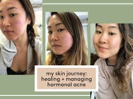 Hormonal acne is an informal term that people use for acne that appears to be caused primarily by hormonal changes. My Hormonal Acne Journey Healing Managing Acne Living Minnaly