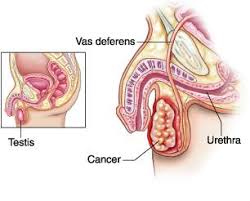 If found early, a testicular tumor may be about. April Is Testicular Cancer Nepal Cancer Relief Society Facebook